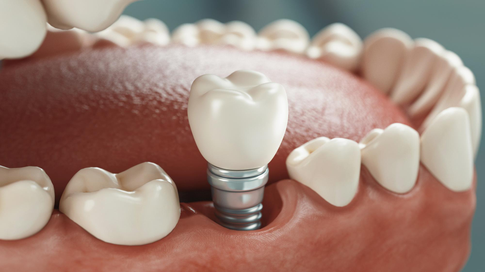 Dental Implants in Maumee
