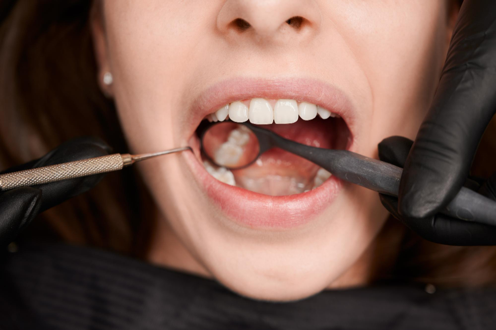 Fillings in  Maumee, OH